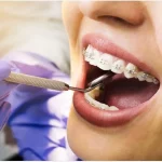 Does Straightening Teeth With Dental Braces Hurt? 