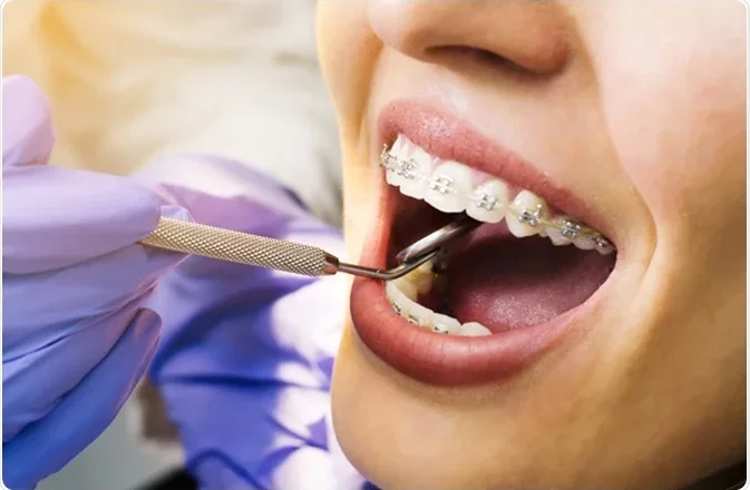 Does Straightening Teeth With Dental Braces Hurt? 