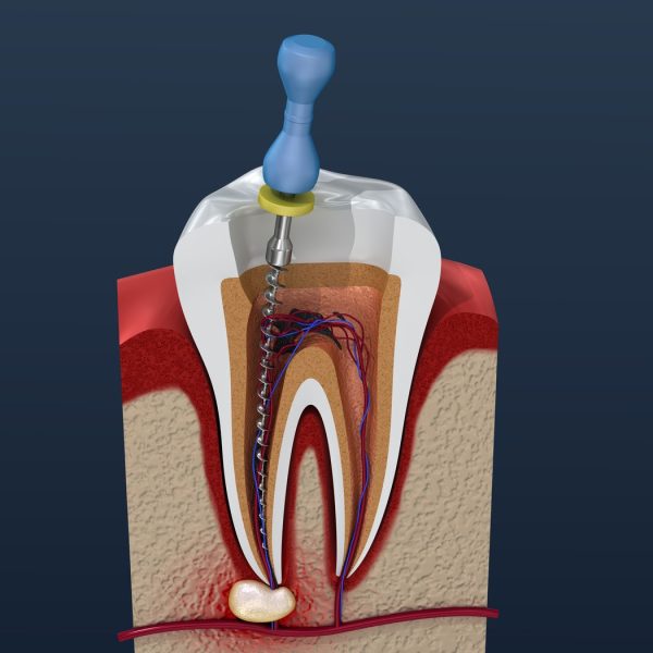 What are Important Facts about Root Canal? 