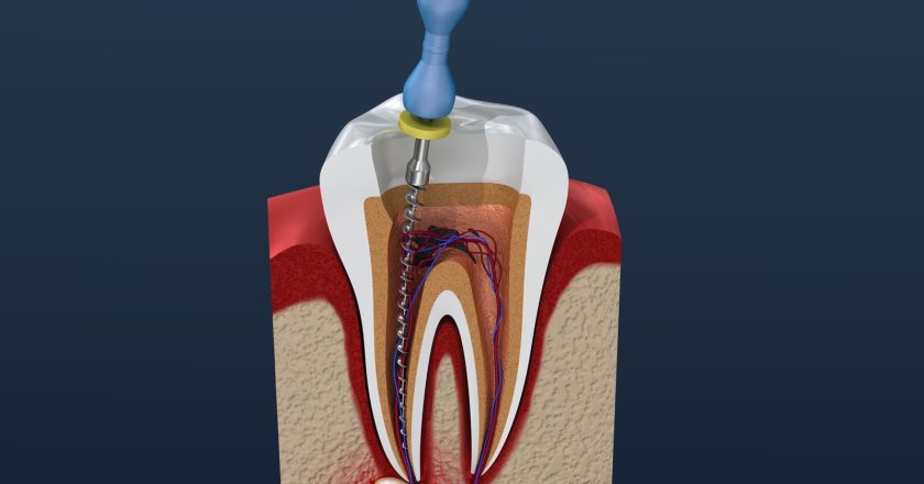 What are Important Facts about Root Canal? 