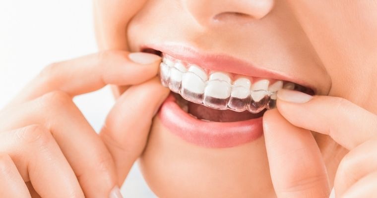 Everything You Need to Know About Invisalign